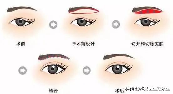 眶周治疗,眶周水肿的处理