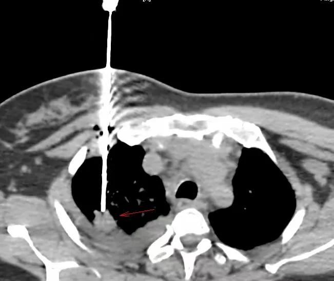肺癌egfr阳性吃靶向药能活几年,肺癌靶向治疗基因检测egfr