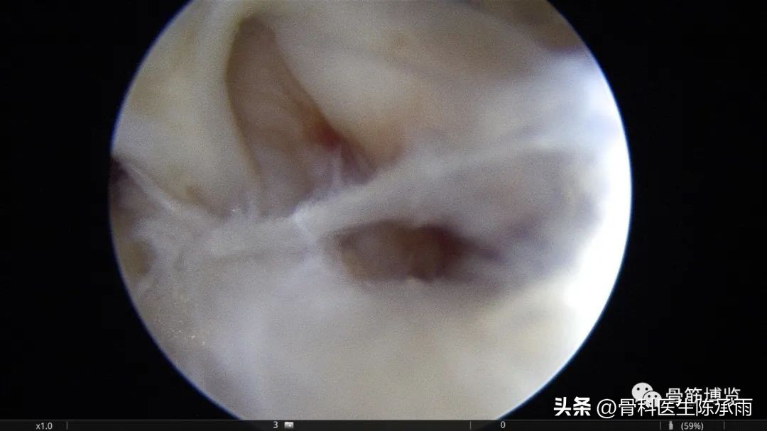 内侧半月板前角囊肿,关节镜下内侧半月板部分切除术