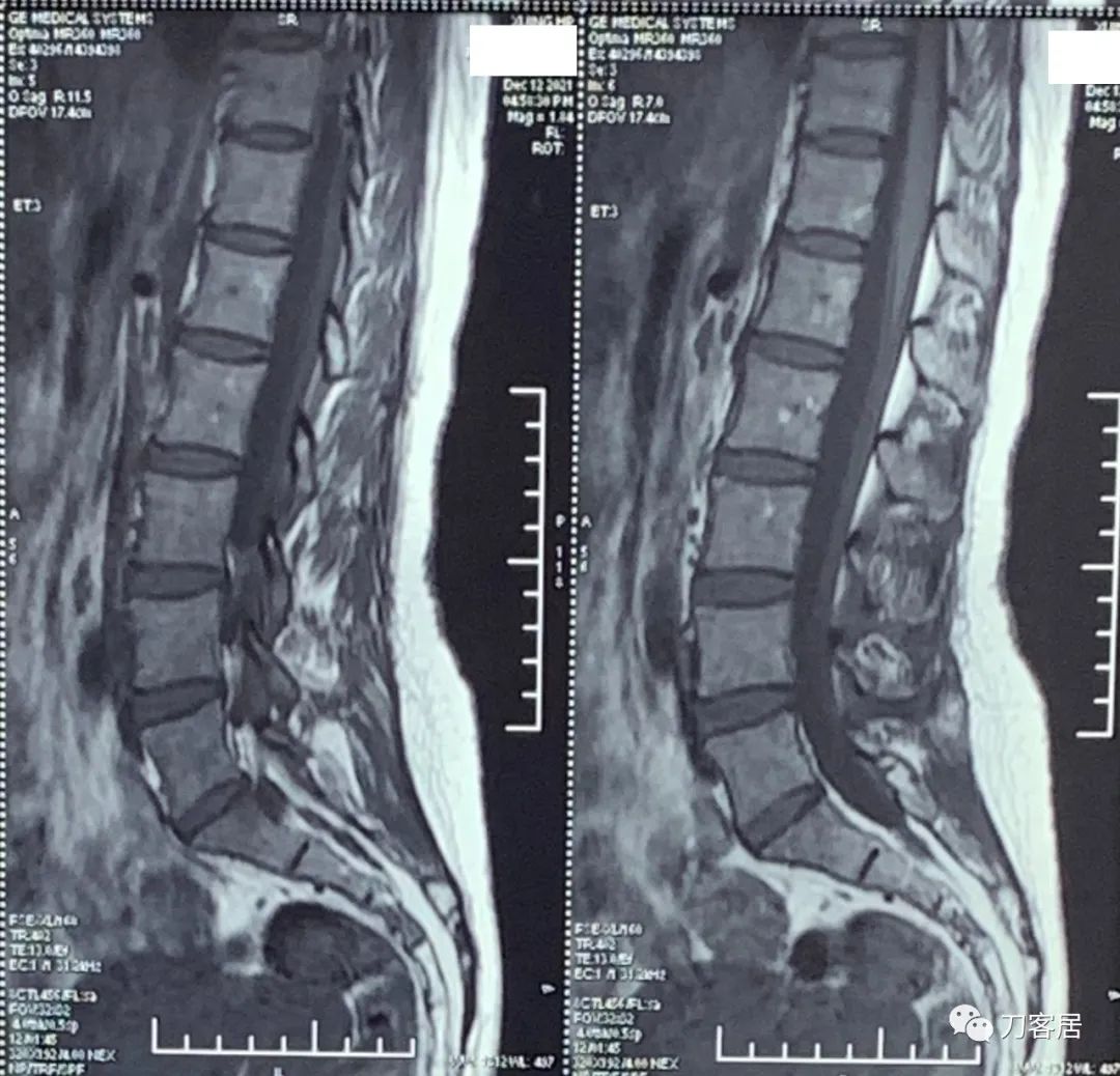 50多岁女性剧烈腰痛,40岁女人腰痛是什么原因引起的