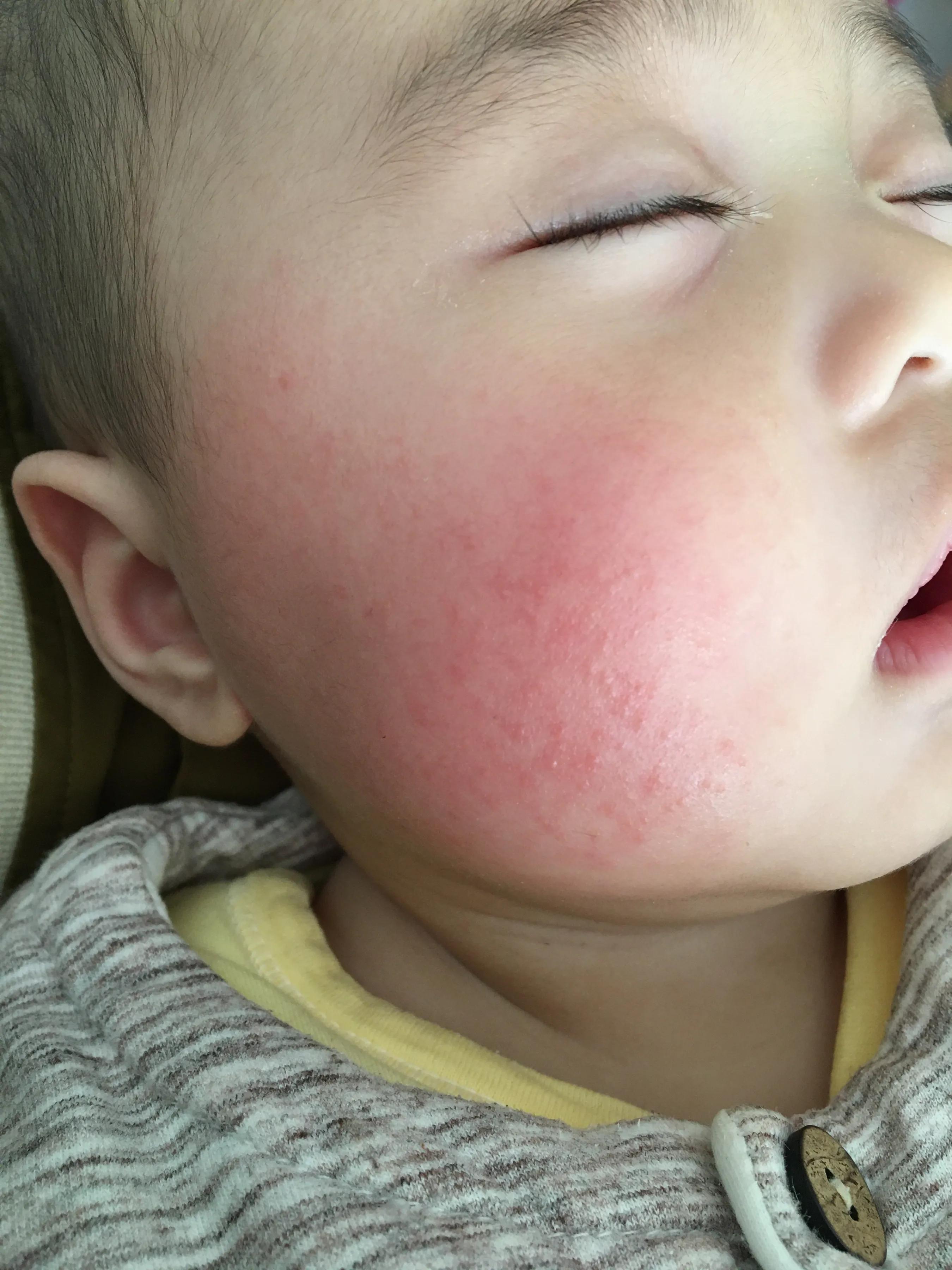 宝宝湿疹大作战,宝宝湿疹反复妈妈需要忌口什么