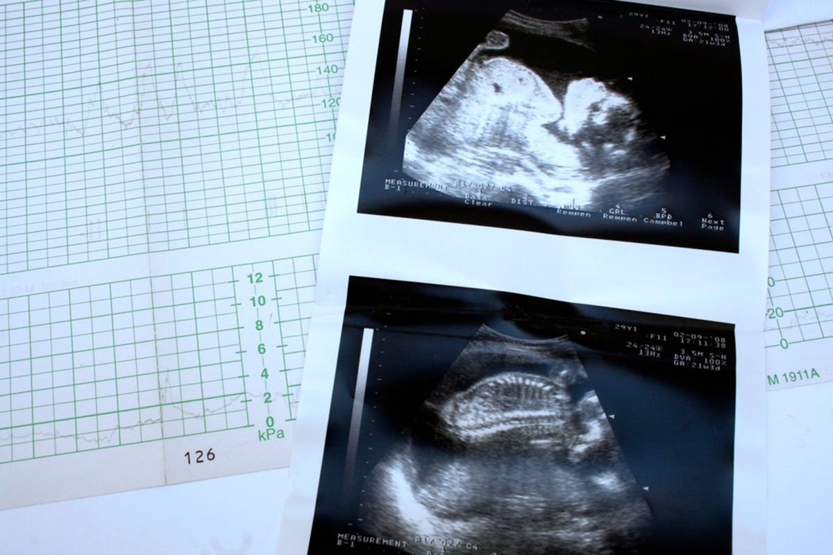 胎心率能辨别胎儿性格吗,看胎心率辨别胎儿有科学依据吗