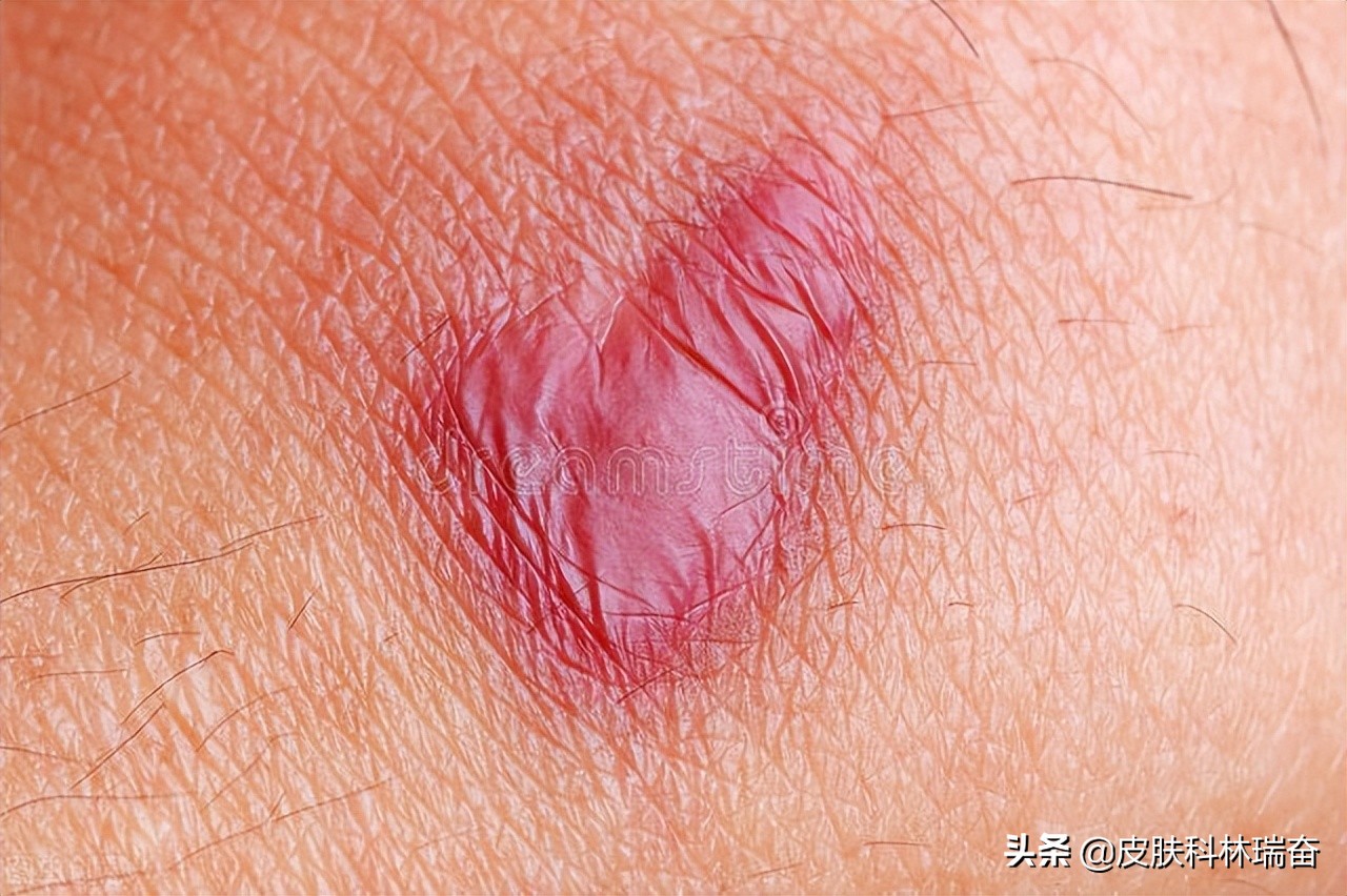 儿童一毫米深的凹陷疤痕怎么处理,各种疤的修复方法