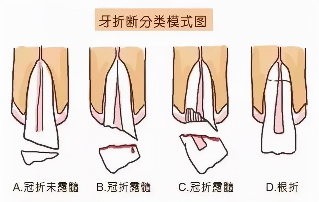 小孩门牙磕断了一个角,十岁孩子磕断门牙怎么办