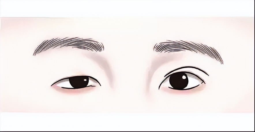 单眼皮大小眼怎么解决,怎么告别大小眼