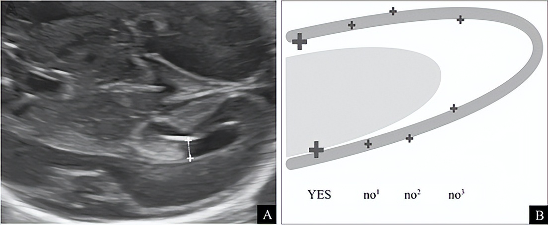续:ISUOG实践指南(更新版):胎儿中枢神经系统超声检查(5)
