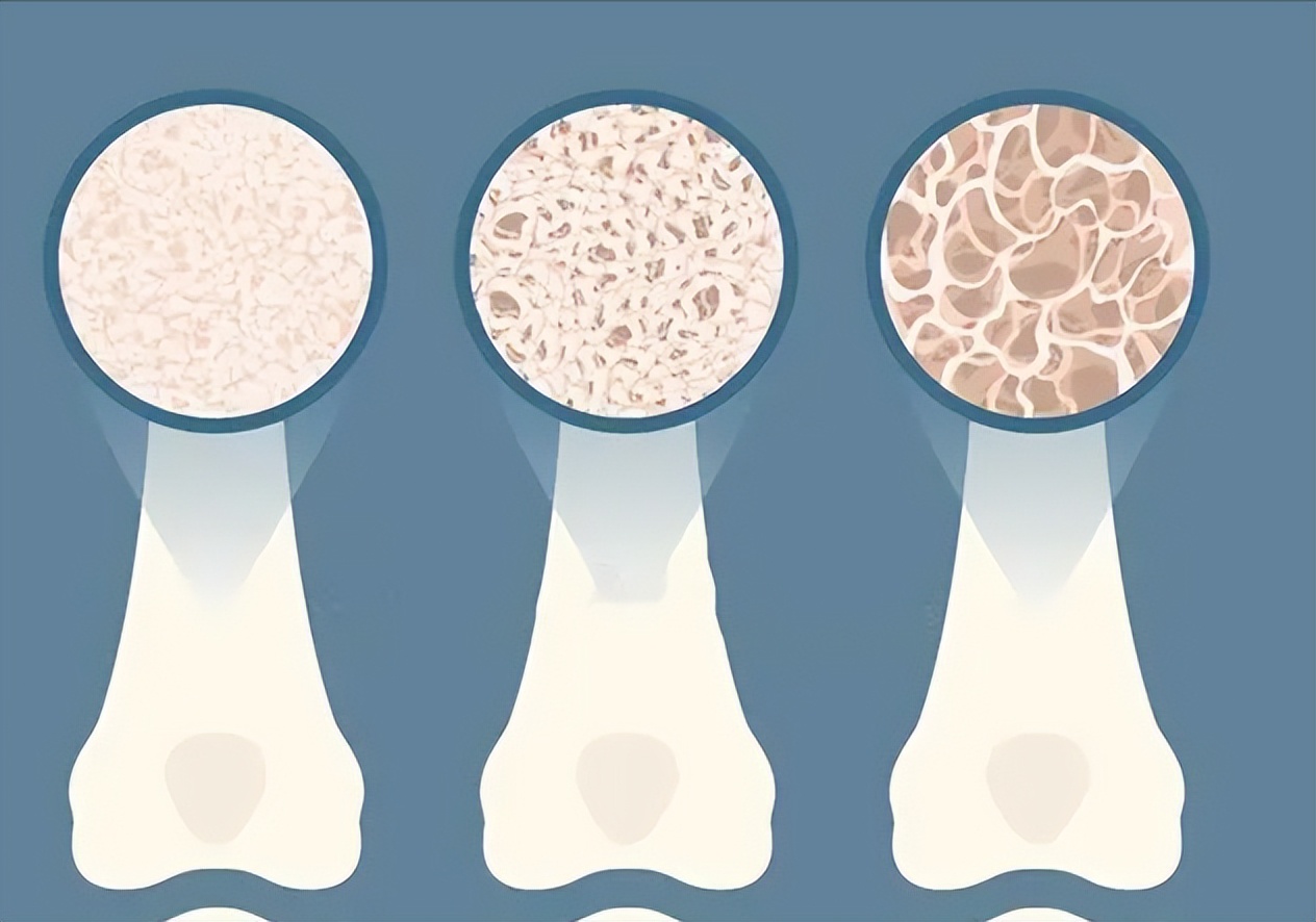 骨康胶囊治阴虚还是阳虚,骨康胶囊对骨质疏松有用吗