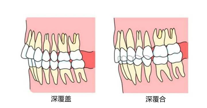 年龄越大凸嘴龅牙会不会越严重,年龄大了龅牙怎么办