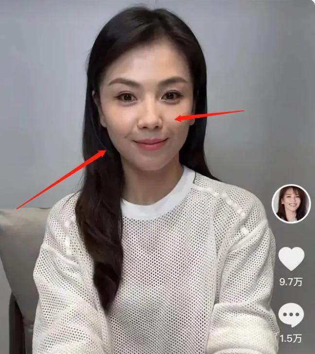 刘涛为什么不填充法令纹,刘涛法令纹怎么去除的