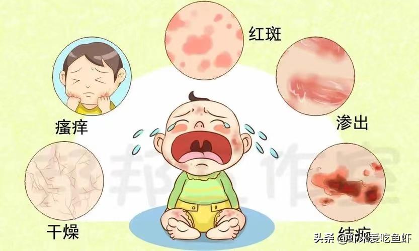 宝宝湿疹怎么保持皮肤干燥,新生儿湿疹皮肤怎样保湿