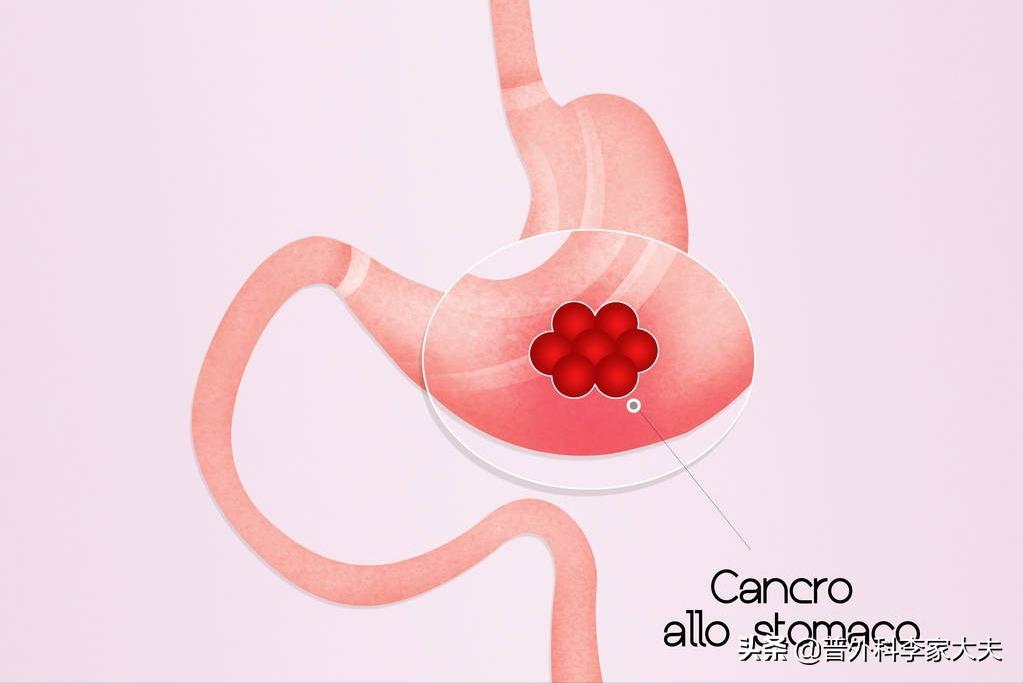 胃癌晚期会出现哪些征兆呢,胃癌晚期最严重的征兆