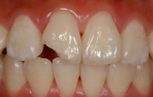 大牙崩掉一小块怎么办,补过的牙侧面被崩掉了一块怎么办