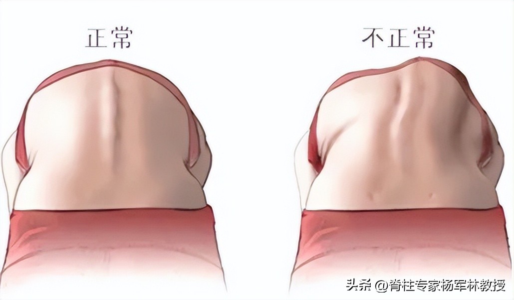 脊柱侧弯10度会出现剃刀背吗,剃刀背会误诊吗