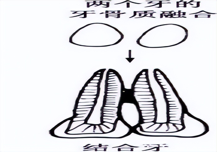 连体畸形牙齿,牙齿有重叠部分可以把牙齿磨小吗