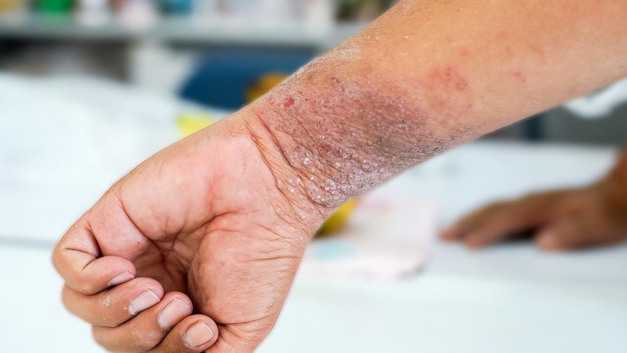 湿疹特别痒用什么药最有效,湿疹很痒用什么药膏最有效