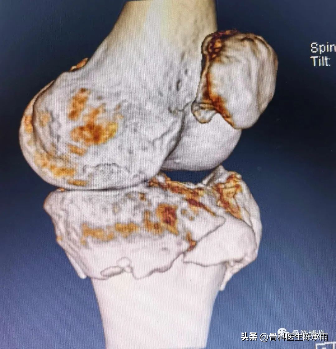 膝关节胫骨平台骨折,最近胫骨平台骨折视频