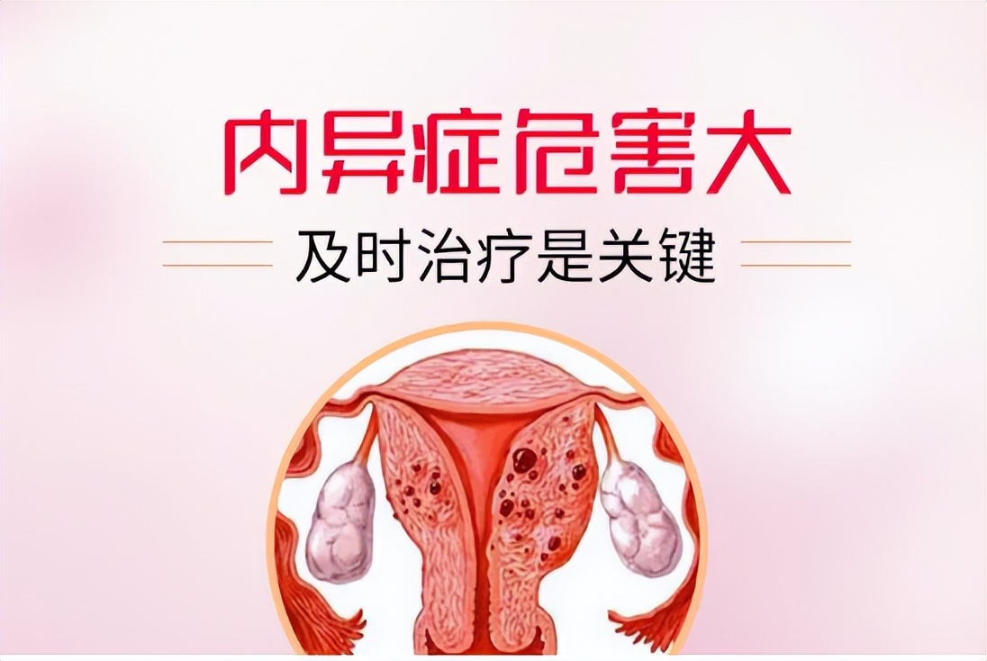 这几类人容易患子宫肌瘤,为什么会得子宫内膜异位症