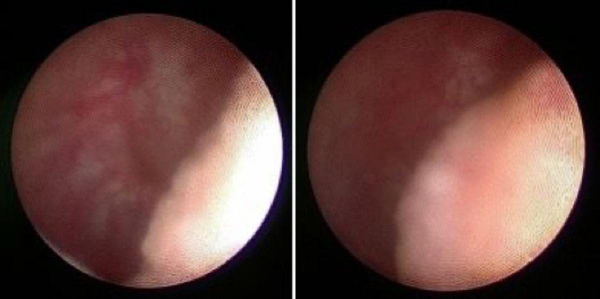 男性梗阻性无精症可以人工授精吗,男科梗阻性无精症