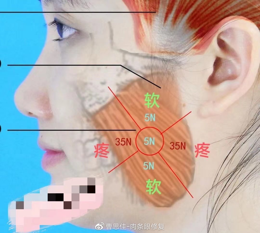 瘦脸针后咬肌为什么更大了,打完瘦脸针咬肌鼓包正常吗