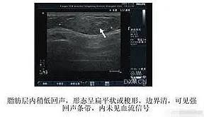 腰部长了一个硬疙瘩像囊肿不疼,腰上长了一个包不痛不痒硬的