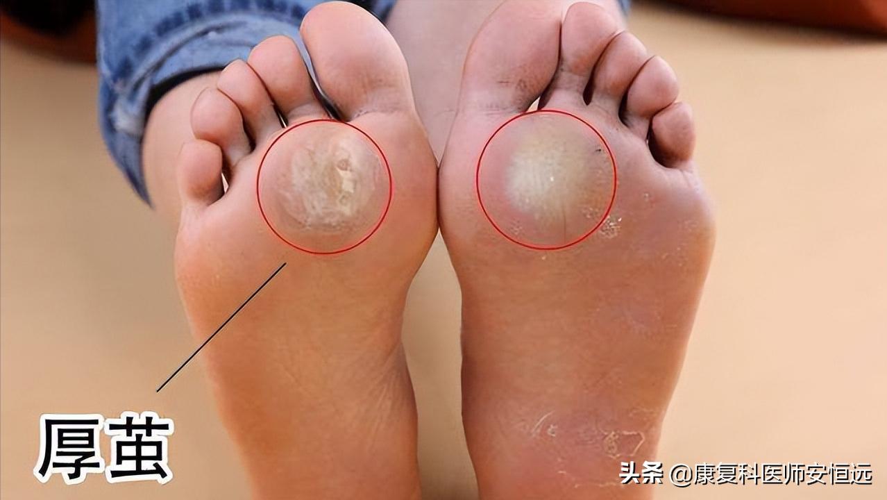 脚底板前面长茧子很疼怎么治疗,脚底板长很厚茧子疼怎么去除