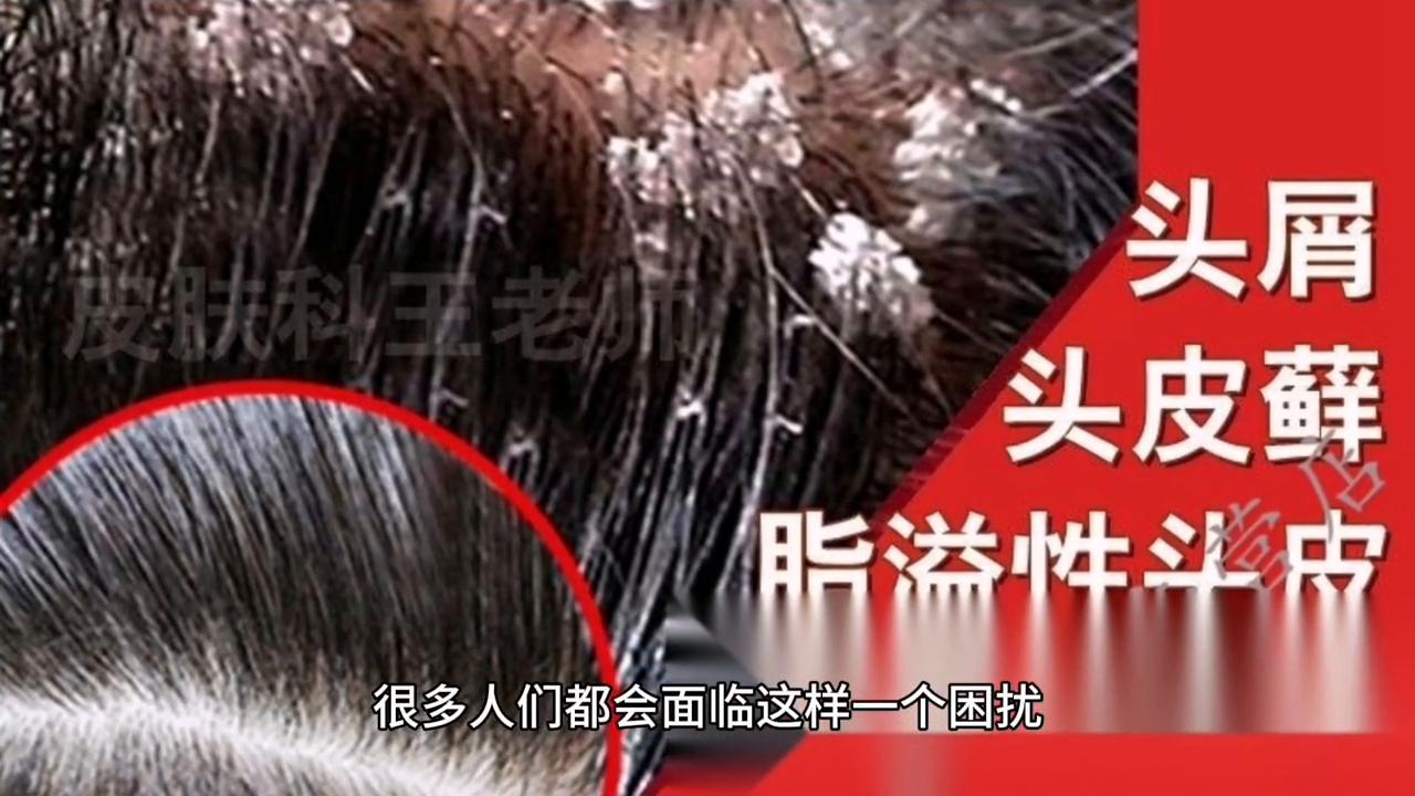 头皮屑有红色结痂,头皮屑有救了