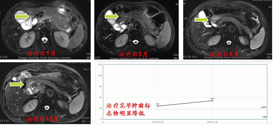因为有你“胰”生平安——重（碳）离子治疗胰腺癌五问