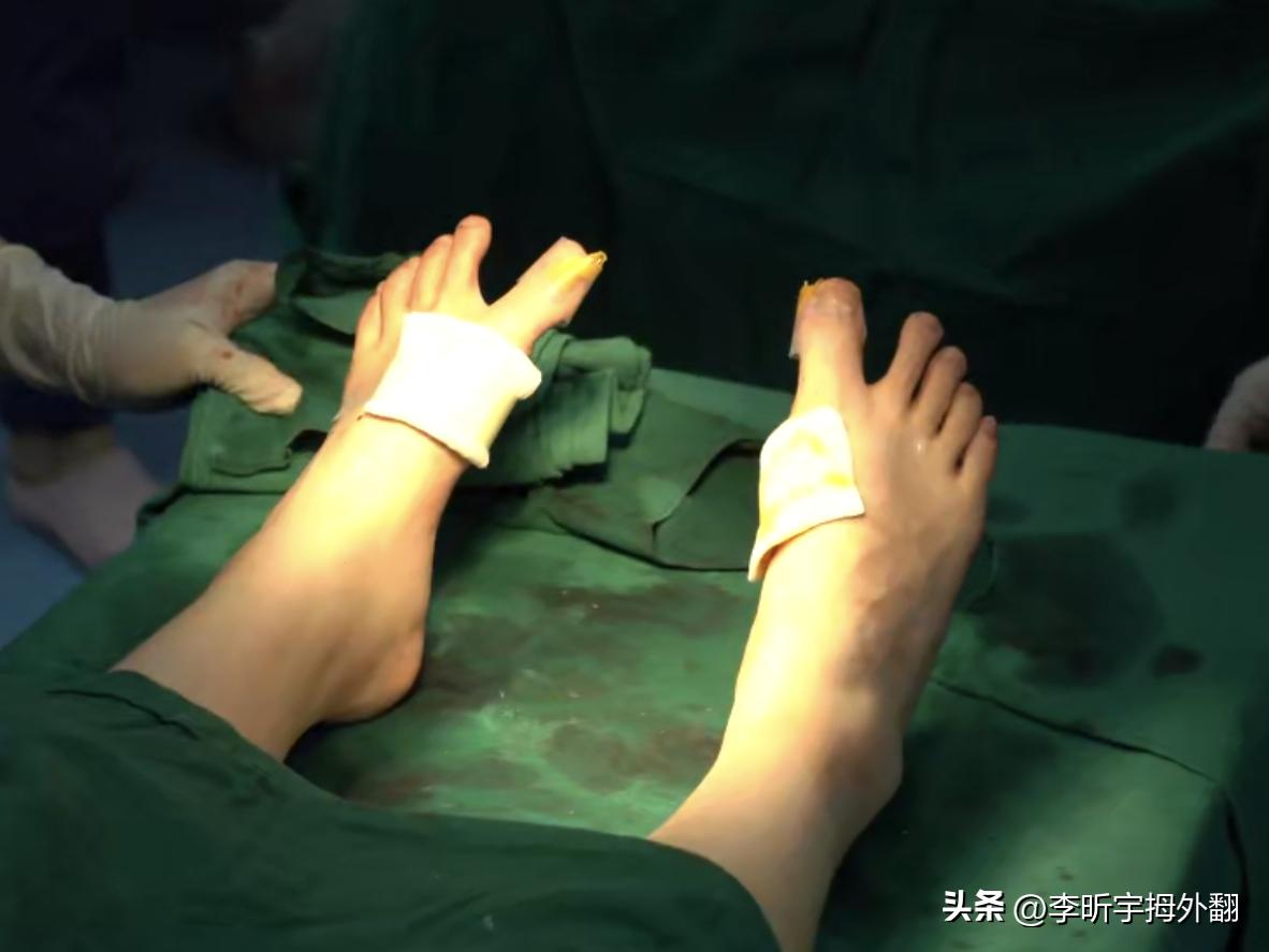 拇外翻术后骨头愈合强度,拇外翻术后伤口开裂