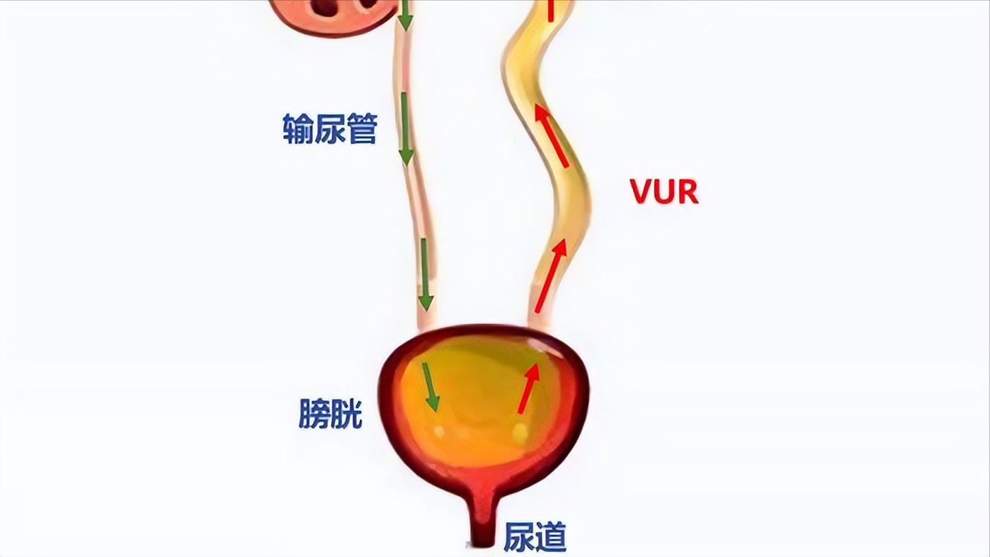 尿路感染多严重才可以感染到肾,切掉一个肾对泌尿系有影响么