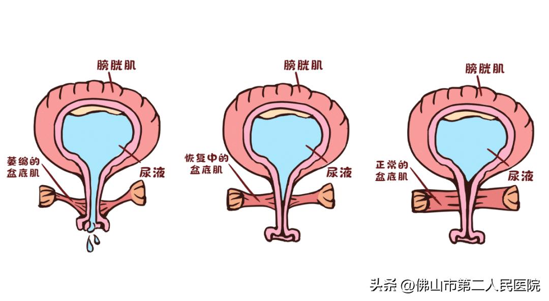产后太松了可以修复吗,产后松了还能恢复吗