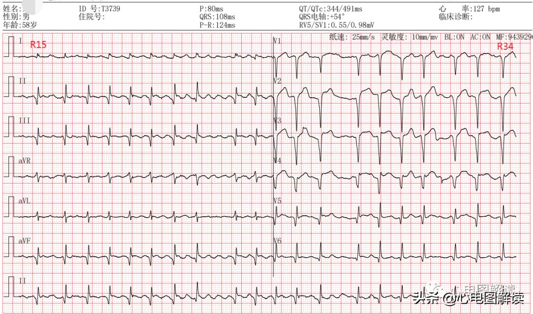 蹇冩埧棰ゅ姩鍗掍腑,鍒濆彂蹇冩埧棰ゅ姩