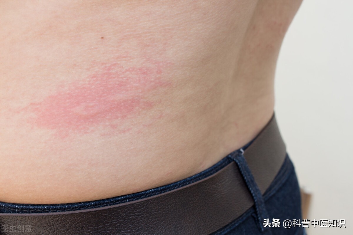 荨麻疹中医祛风治疗,荨麻疹皮肤瘙痒有什么外用药