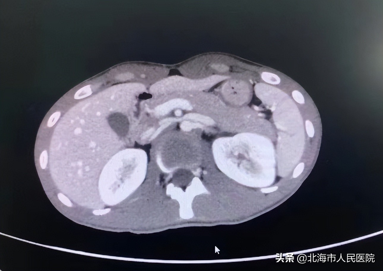 北海一20岁男子骑摩托车摔跤致脾破裂、肾挫伤、频尿血，医生为其微创止血并保住肾脏