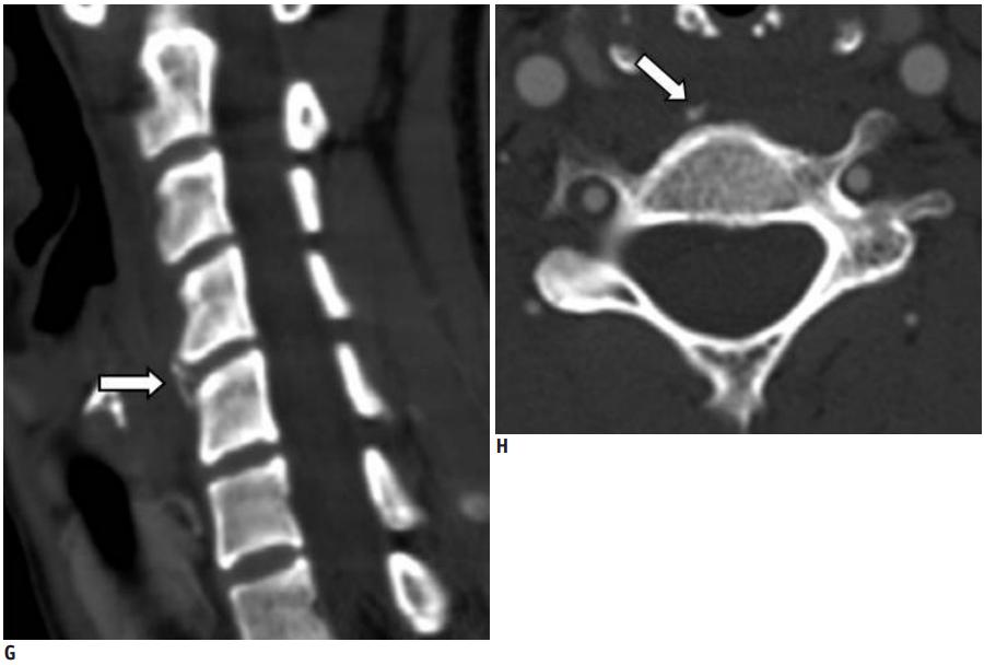 颈椎常见病变图片,颈椎严重的病例