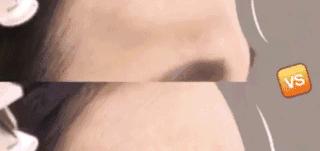 填充额头为什么额头有坑,填充额头过度饱满怎么消除