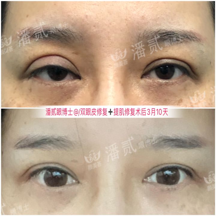 上海宽改窄双眼皮修复案例对比,宽变窄双眼皮修复过程对比