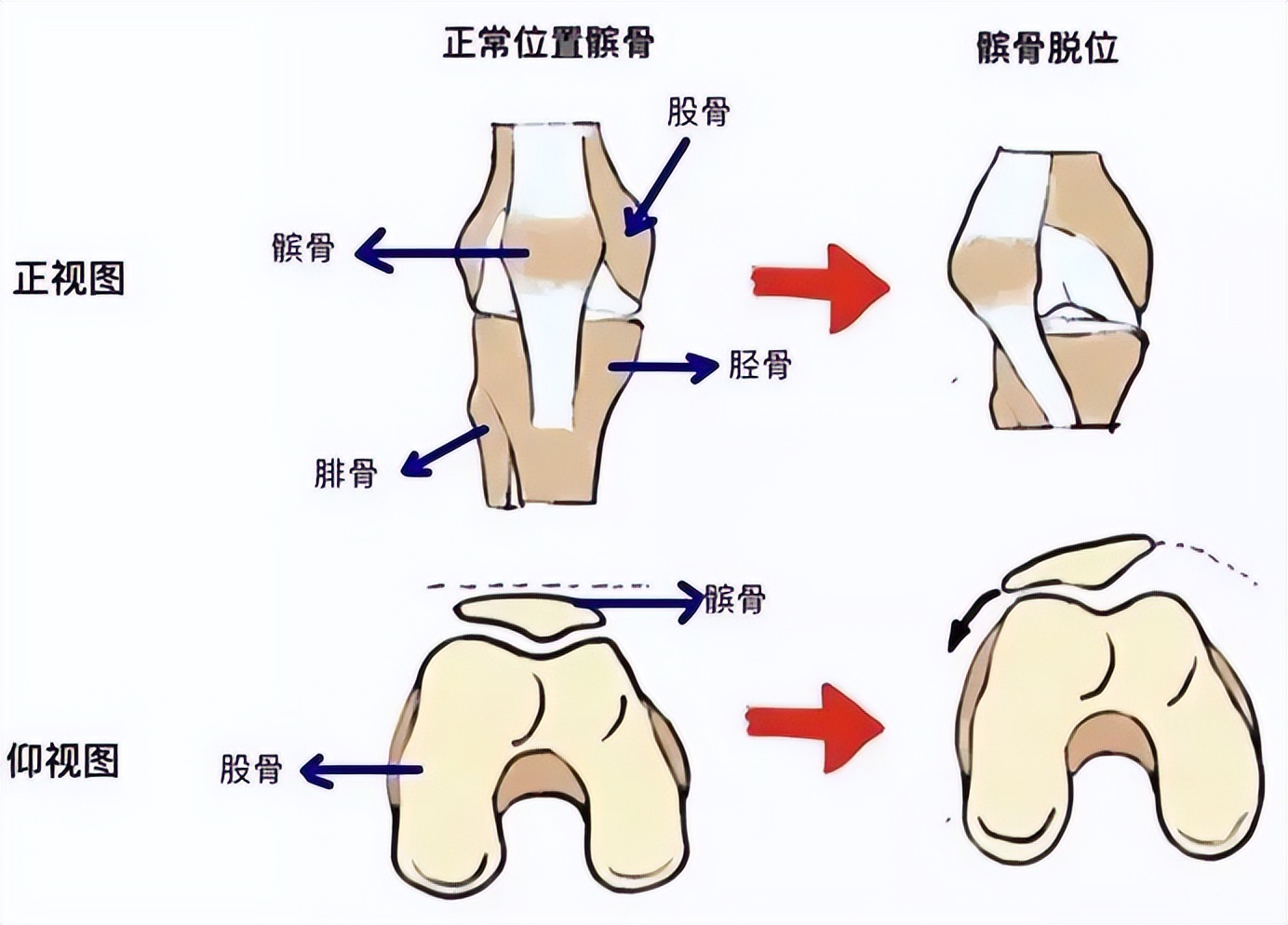 打羽毛球怎么防止肌腱断裂,打羽毛球韧带断裂