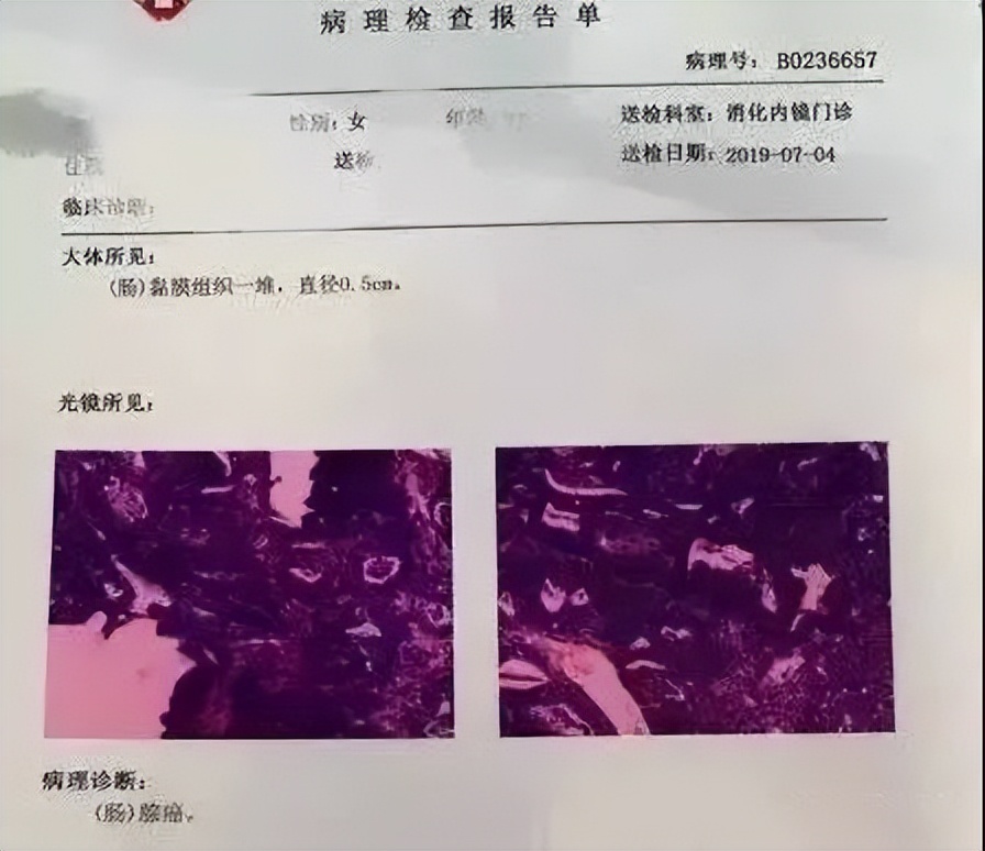 50岁阿姨便血半月，以为是痔疮，一句话引起医生注意，医生：晚了