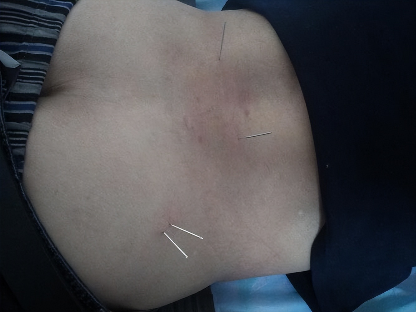 中医无痛治疗?芒针治疗中风后的寒热错杂型消化不良疗效相关研究