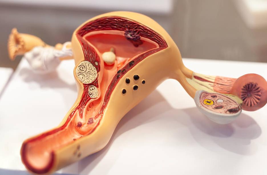 10年没治疗，子宫肌瘤长到4斤，如6个月的婴儿！手术取出109颗