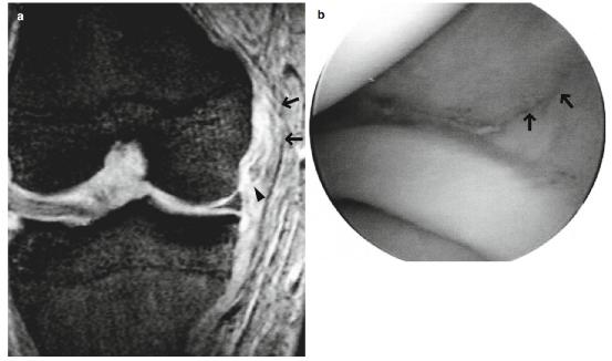 mcl内侧副韧带,内侧副韧带部分撕裂稳定性