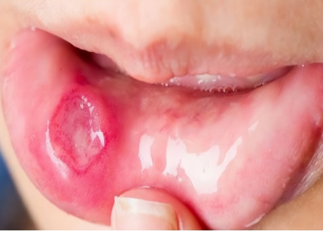 戴牙套以后出现了口腔溃疡怎么办,戴上牙套引起口腔溃疡了怎么办