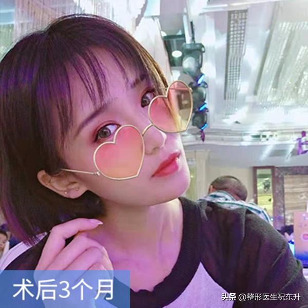 脸部脂肪填充怎样才有立体感,面部脂肪填充后会变的更幼态