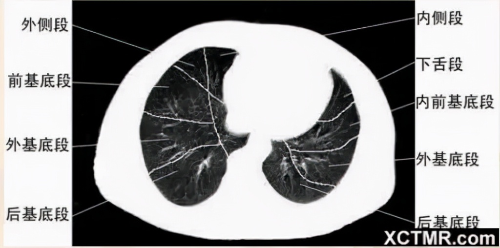 胸腹部盆腔ct主要检查什么,女性盆腔ct断层解剖结构图