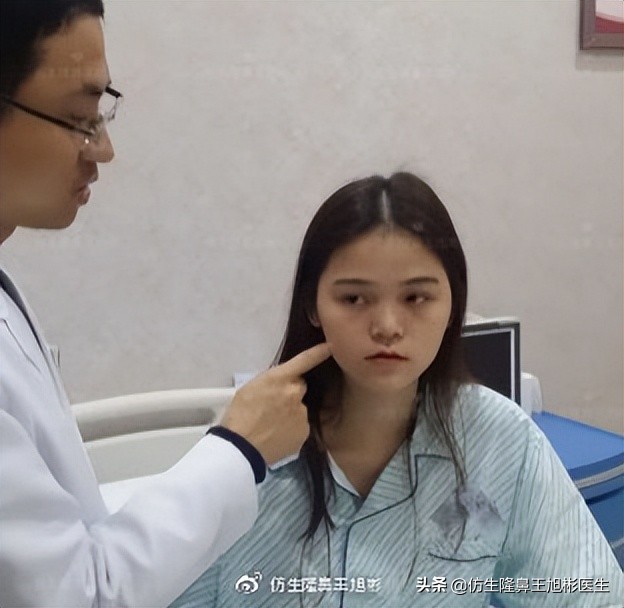 大宽朝天鼻整形过程,窄鼻子如何通过鼻整形来矫正