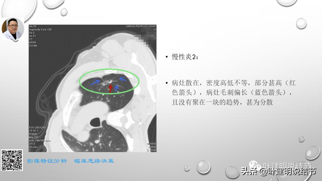 在《一脉阳光》呼吸影像诊断专题培训班上的讲课PPT（第一部分）