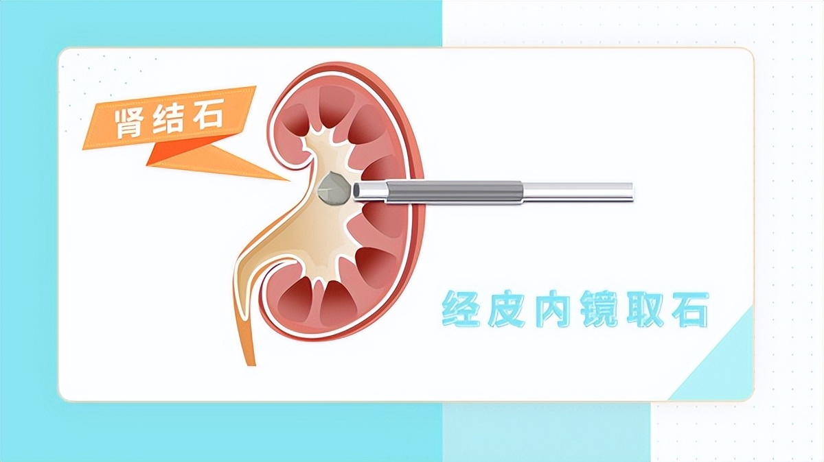 肾结石怎么治才能治好,体检时发现有肾结石需要治疗吗