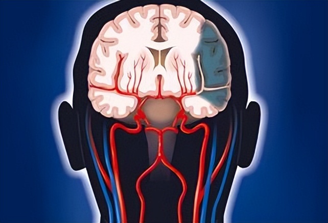 通窍活血汤方剂配伍,中成药溶栓化瘀的治疗效果及疗程