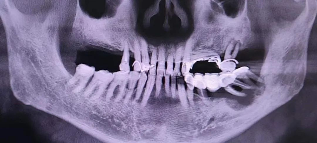 上牙龈红肿不痛且有点溃烂是癌吗,牙龈溃烂是癌症的早期信号么