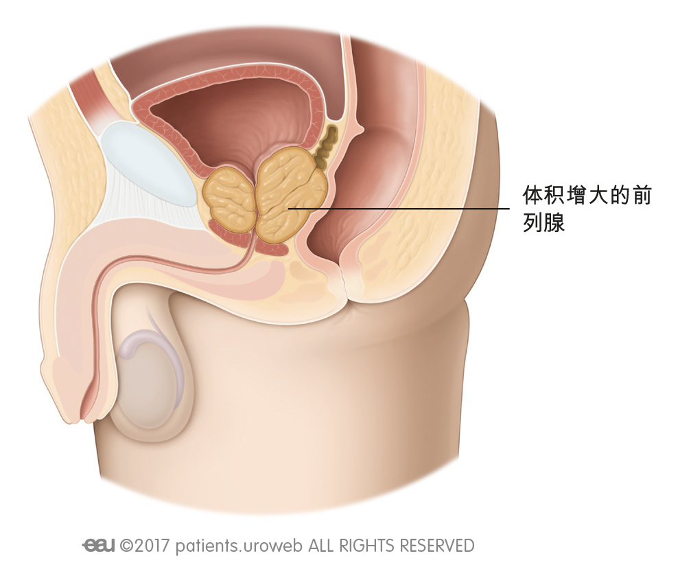 前列腺增生手术电切和激光哪种好,医生告诉你前列腺增生不一定要治